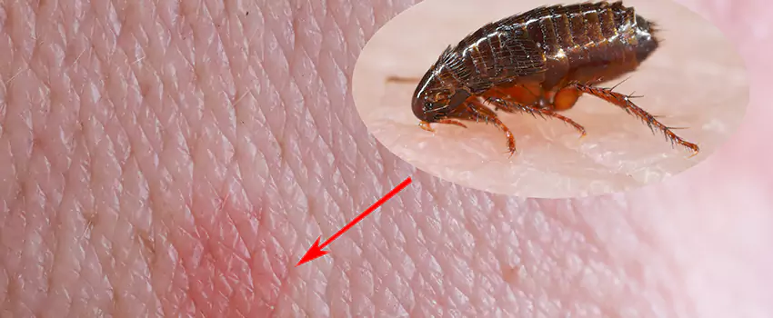 Flea Control for Humans Forney, TX